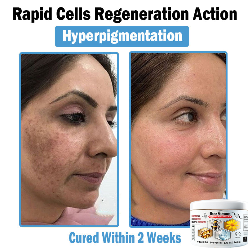 TLOPA® Bee Venom Multi-Symptom Skin Treatment Cream (👨⚕BAD RECOMMENDS)🌟Extra 30% off on sale items!