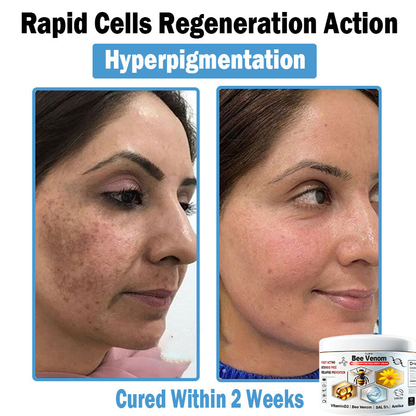 TLOPA® Bee Venom Multi-Symptom Skin Treatment Cream (👨‍⚕BAD RECOMMENDS)🌟Extra 30% off on sale items!