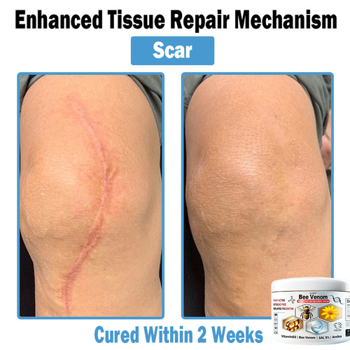 TLOPA® Bee Venom Multi-Symptom Skin Treatment Cream (👨‍⚕BAD RECOMMENDS)🌟Extra 30% off on sale items!