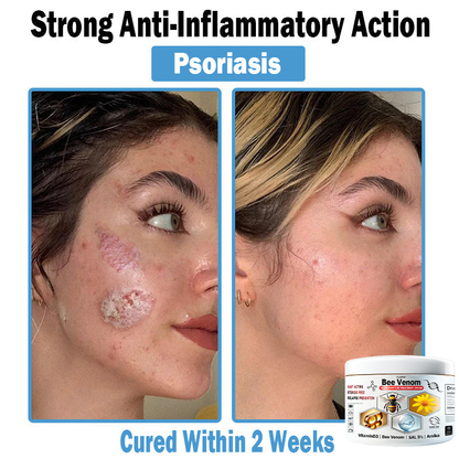 TLOPA® Bee Venom Multi-Symptom Skin Treatment Cream (👨‍⚕BAD RECOMMENDS)🌟Extra 30% off on sale items!