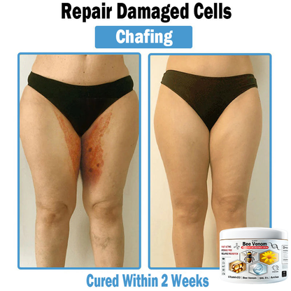 TLOPA® Bee Venom Multi-Symptom Skin Treatment Cream (👨‍⚕BAD RECOMMENDS)🌟Extra 30% off on sale items!