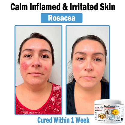 TLOPA® Bee Venom Multi-Symptom Skin Treatment Cream (👨‍⚕BAD RECOMMENDS)🌟Extra 30% off on sale items!